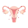Endométriose Endométriose