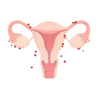 Endométriose Endométriose