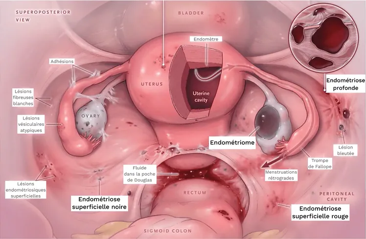 Endométriose — illustration 4